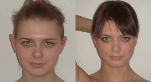 Otoplasty ของหูที่ยื่นออกมา