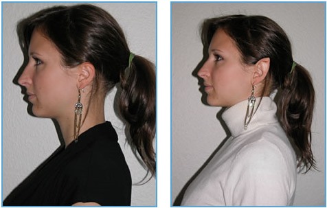 Otoplasty - หูพราย