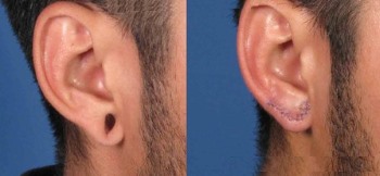 Otoplasty หลังอุโมงค์