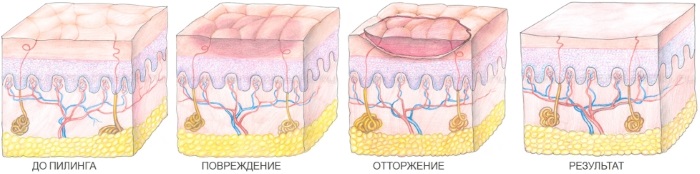 Жути пилинг, ретиноик - шта је то, како то учинити код куће