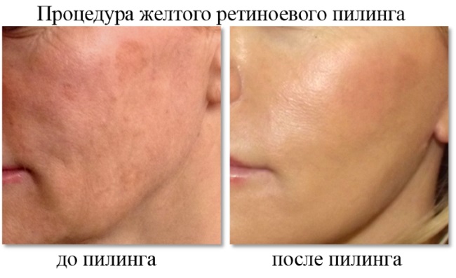 Жути пилинг, ретиноик - шта је то, како то учинити код куће