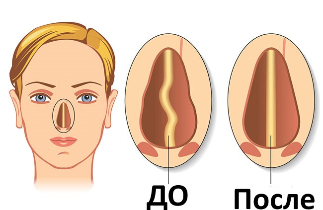 رأب الحاجز الأنفي. ما هو ، جراحة الحاجز الأنفي ، الليزر ، المؤشرات