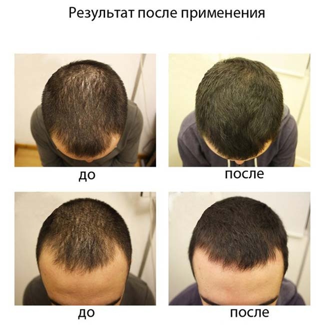 Лек за губитак косе код жена и мушкараца у апотекама