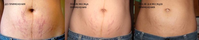 Како сакрити стрије на стомаку: уз помоћ процедура, тетоважа, ласера, фотографије