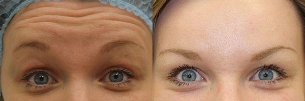 Suntikan Botox di dahi. Hasil, gambar sebelum dan selepas, akibat, ulasan
