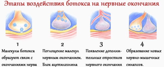 Suntikan Botox di dahi. Hasil, gambar sebelum dan selepas, akibat, ulasan