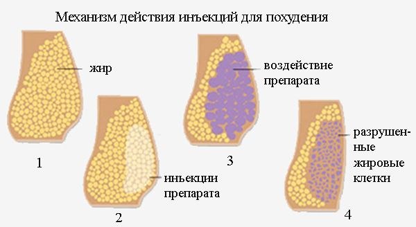 Ињекције за мршављење у стомаку. Ињекције озона, липолитици, Акуалик, прегледи, цене