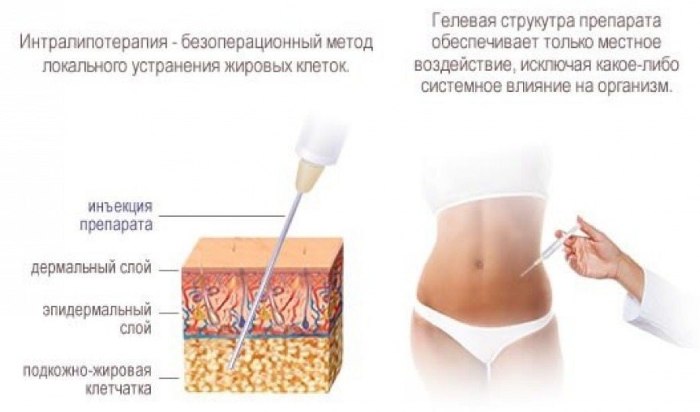 Ињекције за мршављење у стомаку. Ињекције озона, липолитици, Акуалик, прегледи, цене