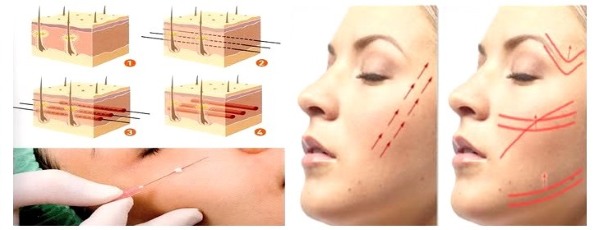 Nâng mí mắt không phẫu thuật. Các bài tập, bôi kem, Zhdanov nâng cơ, nâng cơ da, đắp mặt nạ tại nhà. Nhận xét