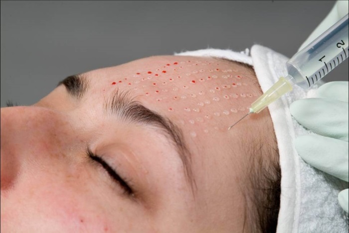 Bioreparation - nó là gì, hoạt động của quy trình, tác dụng, những loại thuốc được sử dụng: Gialripier, Aquashine, hình ảnh, giá cả, đánh giá