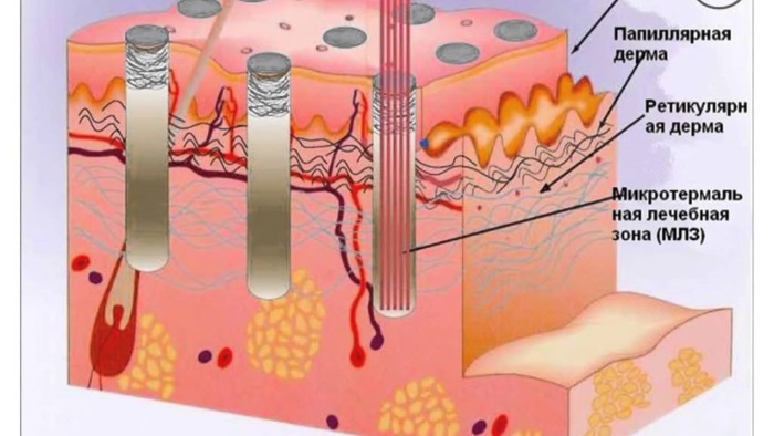 Bioreparation - nó là gì, hoạt động của quy trình, tác dụng, những loại thuốc được sử dụng: Gialripier, Aquashine, hình ảnh, giá cả, đánh giá