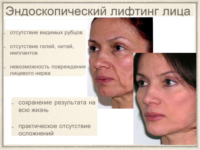 Шта је ендоскопски лифтинг лица