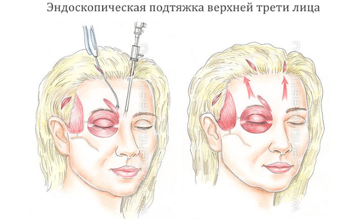 Шта је ендоскопски лифтинг лица
