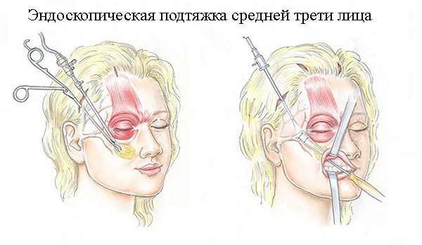Шта је ендоскопски лифтинг лица
