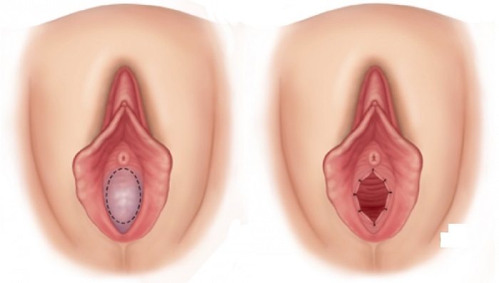 Hymenoplasty - apakah itu, sebelum dan selepas gambar, peringkat operasi, hasil, pemulihan dan kemungkinan komplikasi