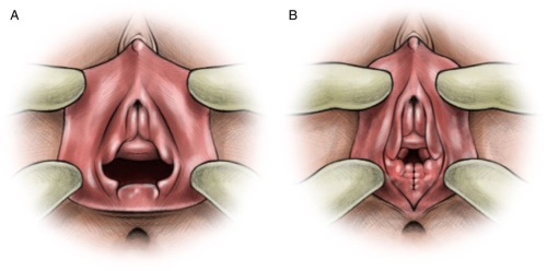 Hymenoplasty - apakah itu, sebelum dan selepas gambar, peringkat operasi, hasil, pemulihan dan kemungkinan komplikasi
