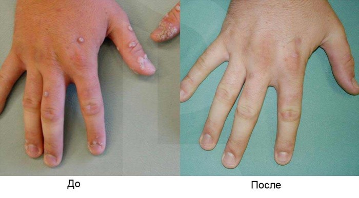 Како се отарасити папилома, уклањање ласером на врату, телу, лицу, интимним местима. Кућно лечење