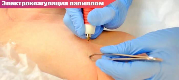Како се отарасити папилома, уклањање ласером на врату, телу, лицу, интимним местима. Кућно лечење