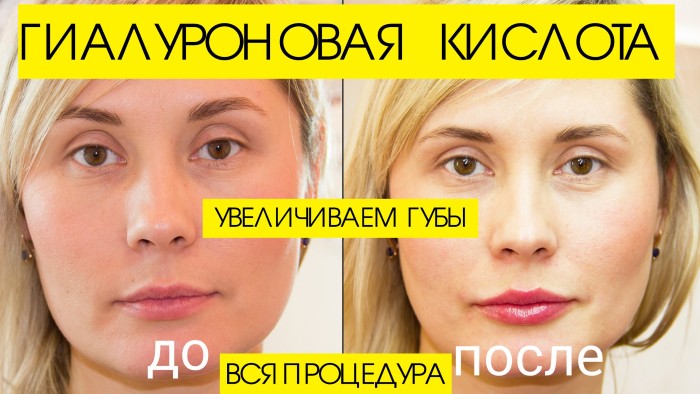 Контурирање усана - техника повећања хијалуронском киселином, пунила. Фотографије и цене