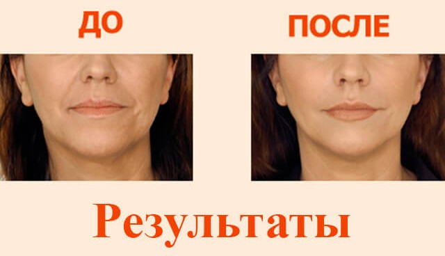 Контурирање усана - техника повећања хијалуронском киселином, пунила. Фотографије и цене