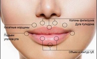Контурирање усана - техника повећања хијалуронском киселином, пунила. Фотографије и цене