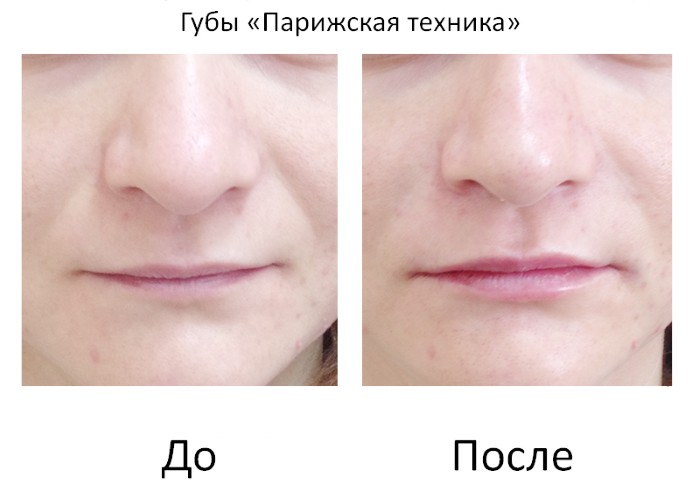 Контурирање усана - техника повећања хијалуронском киселином, пунила. Фотографије и цене