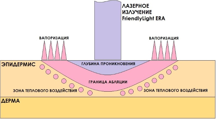 Tái tạo bề mặt da bằng laser cho các vết sẹo và sẹo. Hình ảnh trước và sau, giá cả, đánh giá. Chăm sóc da tại nhà sau liệu trình
