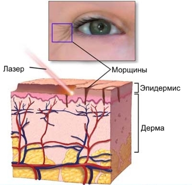 Tái tạo bề mặt da bằng laser cho các vết sẹo và sẹo. Hình ảnh trước và sau, giá cả, đánh giá. Chăm sóc da tại nhà sau liệu trình