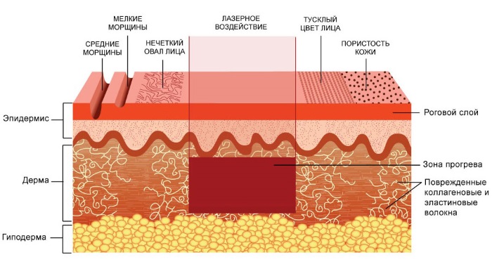 Tái tạo bề mặt da bằng laser cho các vết sẹo và sẹo. Hình ảnh trước và sau, giá cả, đánh giá. Chăm sóc da tại nhà sau liệu trình
