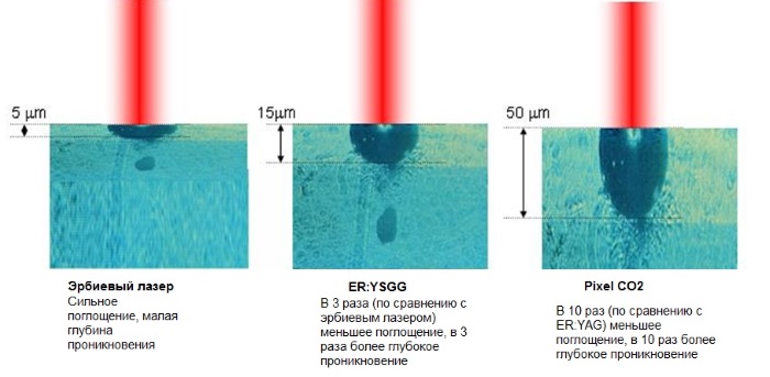 Tái tạo bề mặt da bằng laser cho các vết sẹo và sẹo. Hình ảnh trước và sau, giá cả, đánh giá. Chăm sóc da tại nhà sau liệu trình