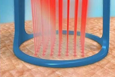 Tái tạo bề mặt da bằng laser cho các vết sẹo và sẹo. Hình ảnh trước và sau, giá cả, đánh giá. Chăm sóc da tại nhà sau liệu trình