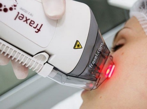 Tái tạo bề mặt da bằng laser cho các vết sẹo và sẹo. Hình ảnh trước và sau, giá cả, đánh giá. Chăm sóc da tại nhà sau liệu trình