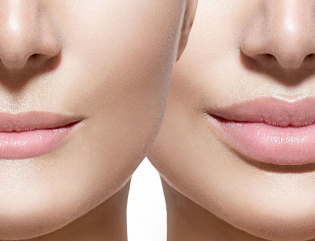Nâng môi bằng axit hyaluronic. Hình ảnh trước và sau khi làm thủ thuật, đánh giá. Tiêm bao nhiêu tiền
