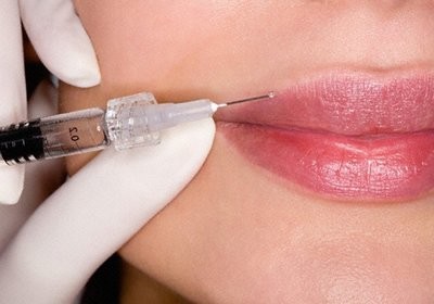 Nâng môi bằng axit hyaluronic. Hình ảnh trước và sau khi làm thủ thuật, đánh giá.Tiêm bao nhiêu tiền