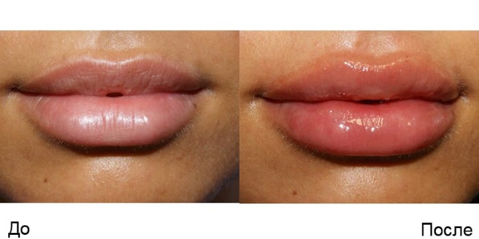 Nâng môi bằng axit hyaluronic. Hình ảnh trước và sau khi làm thủ thuật, đánh giá. Tiêm bao nhiêu tiền