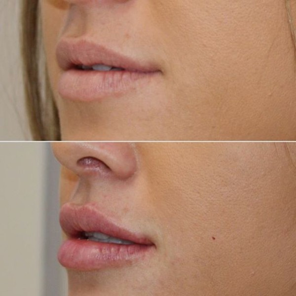 Nâng môi bằng axit hyaluronic. Hình ảnh trước và sau khi làm thủ thuật, đánh giá. Tiêm bao nhiêu tiền