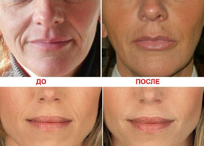 Nâng môi bằng axit hyaluronic. Hình ảnh trước và sau khi làm thủ thuật, đánh giá. Tiêm bao nhiêu tiền