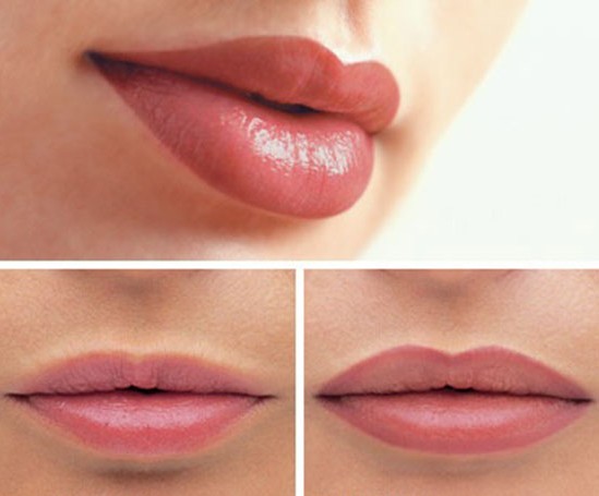 Nâng môi bằng axit hyaluronic. Hình ảnh trước và sau khi làm thủ thuật, đánh giá. Tiêm bao nhiêu tiền
