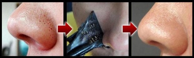 Mặt nạ than và gelatin trị mụn đầu đen. Công thức, đánh giá