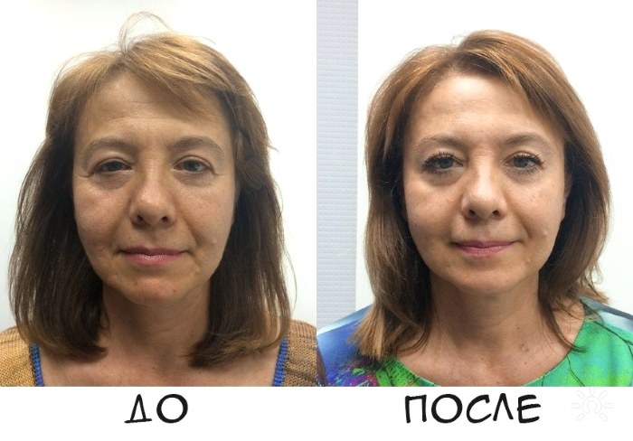 Gouache massage - là gì, kỹ thuật thực hiện, cách thực hiện cho mặt, lưng, ảnh trước và sau