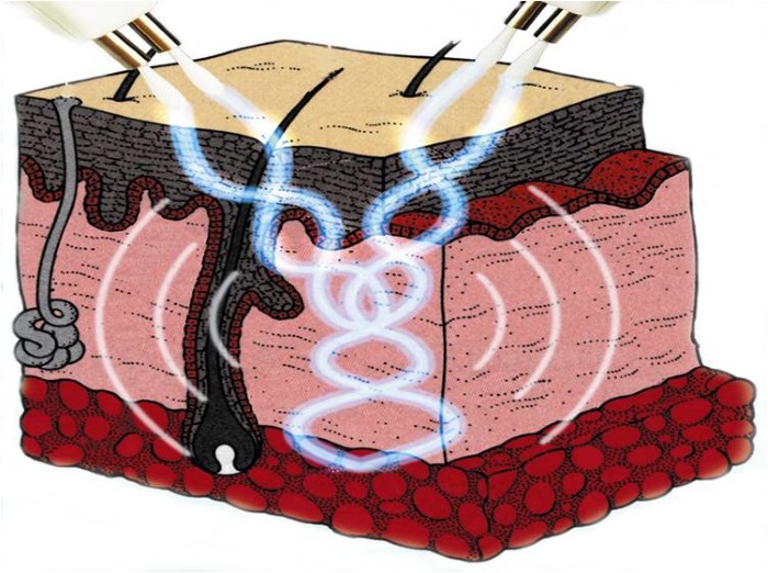 Dòng điện vi mô cho khuôn mặt trong thẩm mỹ - một quy trình trị liệu bằng máy. Giá cả, đánh giá