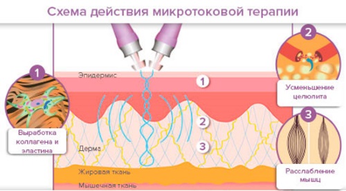 Dòng điện vi mô cho khuôn mặt trong thẩm mỹ - một quy trình trị liệu bằng máy. Giá cả, đánh giá
