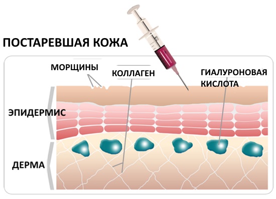 Liệu pháp Plasma - Plasmolifting của da mặt và cổ, chỉ định, chống chỉ định, hình ảnh, giá của thủ thuật, đánh giá