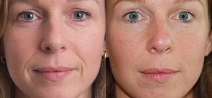 Liệu pháp Plasma - Plasmolifting của da mặt và cổ, chỉ định, chống chỉ định, hình ảnh, giá của thủ thuật, đánh giá
