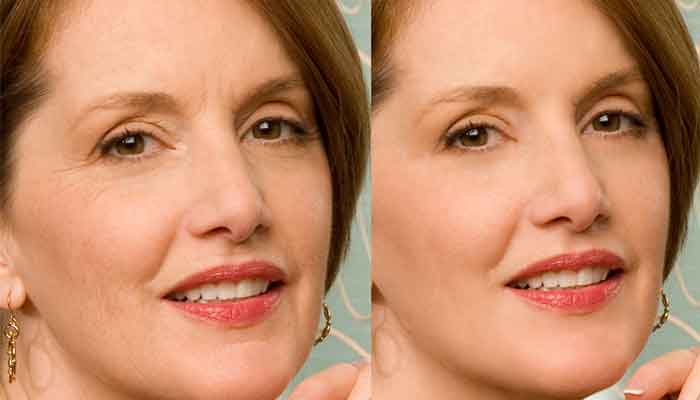 Liệu pháp Plasma - Plasmolifting của da mặt và cổ, chỉ định, chống chỉ định, hình ảnh, giá của thủ thuật, đánh giá