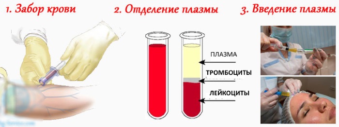 Liệu pháp Plasma - Plasmolifting của da mặt và cổ, chỉ định, chống chỉ định, hình ảnh, giá của thủ thuật, đánh giá