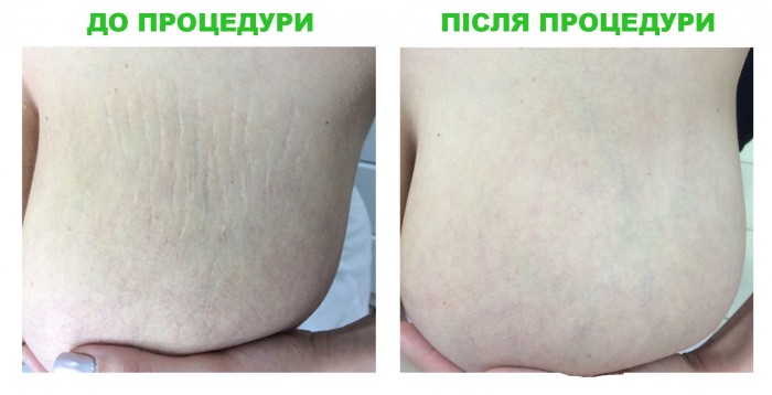 Стрије код трудница, адолесцената на телу, стомаку, грудима, ногама, задњици, леђима. Разлози за уклањање