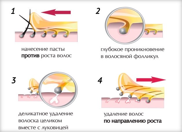 Sugaring diện bikini khoét sâu. Video, hình ảnh trước sau, cách tự làm tại nhà