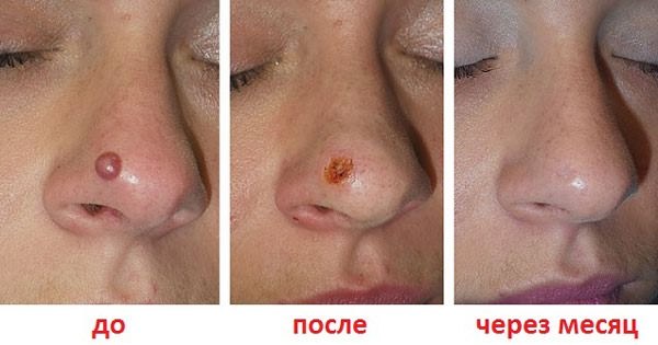Tẩy nốt ruồi bằng laser, phương pháp phẫu thuật, tại nhà. Hậu quả, vết thương bao lâu lành, sẹo