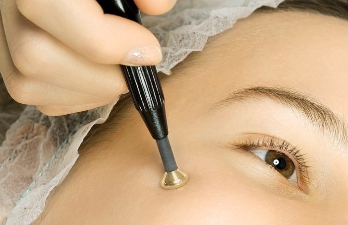 Tẩy nốt ruồi bằng laser, phương pháp phẫu thuật, tại nhà. Hậu quả, vết thương bao lâu lành, sẹo